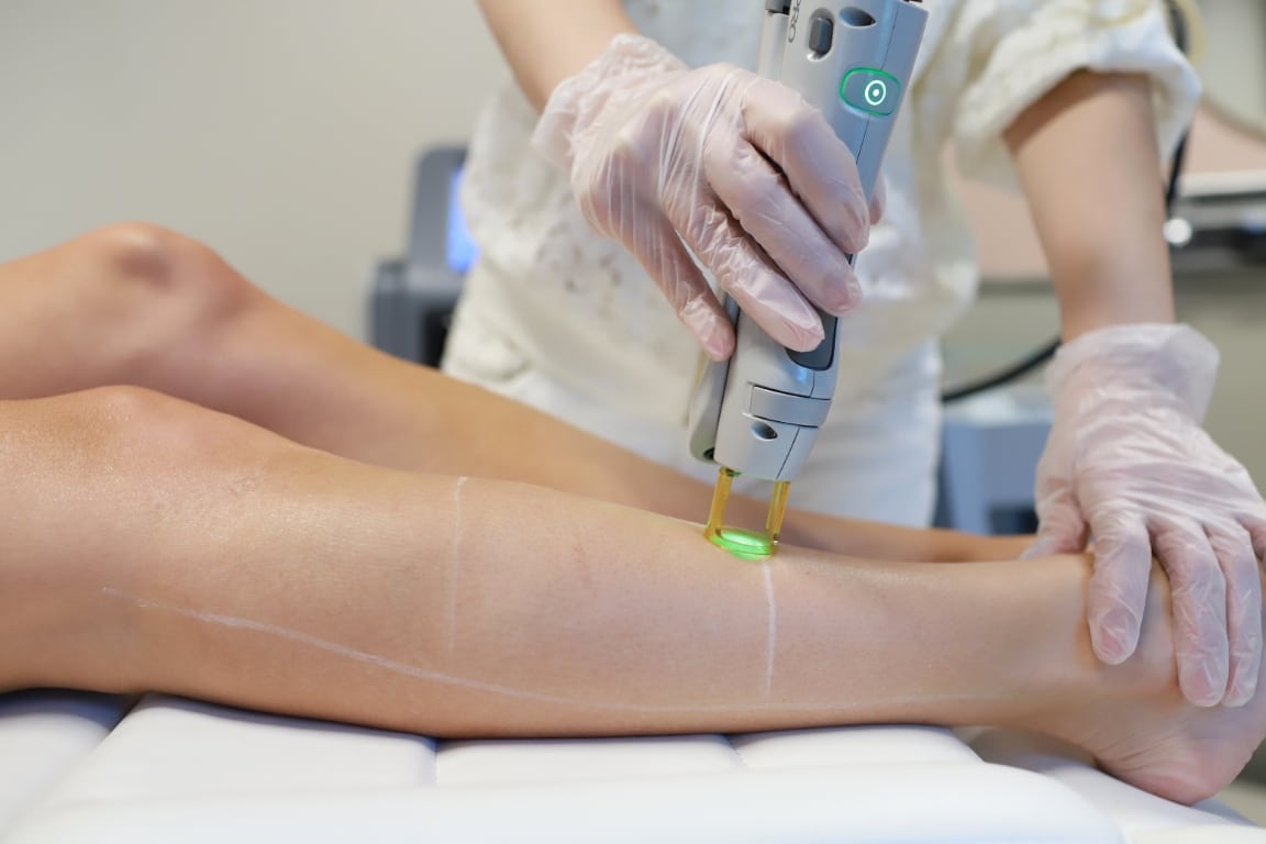 Laserontharing behandeling